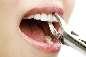 Линия улыбки Лечение кисты