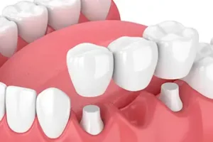 Линия улыбки Линия улыбки Несъемные зубные протезы