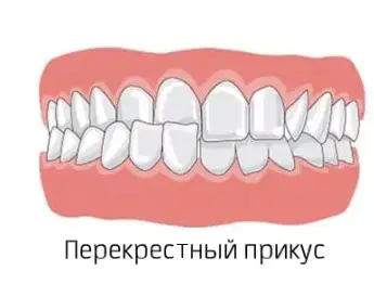 Линия улыбки Линия улыбки Исправление прикуса